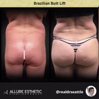 Brazilian Butt Lift in Seattle (BBL) by Dr. Sajan aka Real Dr. Seattle