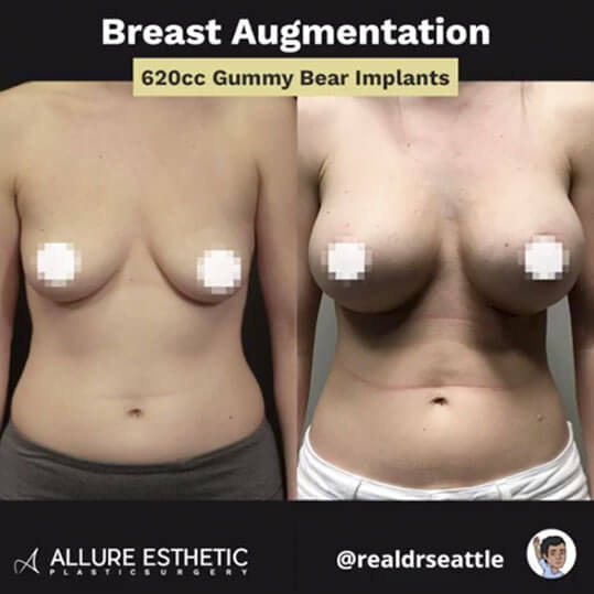 Seattle Breast Augmentation Before & After Pictures | RealDrSeattle