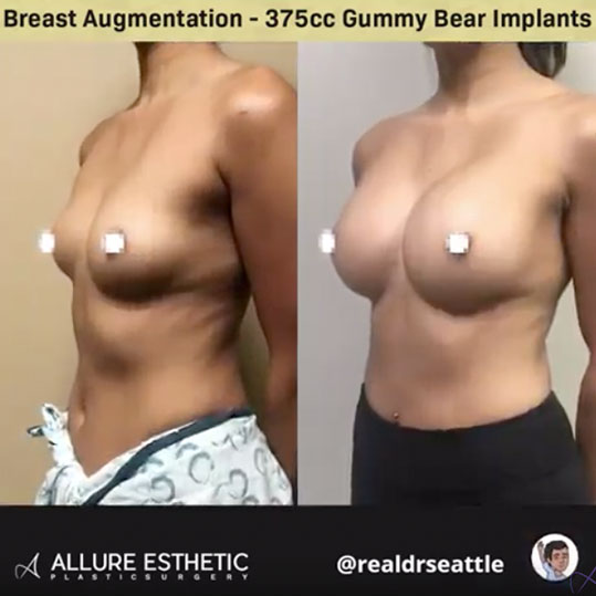 Seattle's Top Plastic Surgeon - Before and Afters - 375cc Gummy Implants