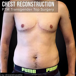Chest Reconstruction - Female to Male - Before & After Pictures