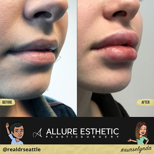 Restylane-L Lip Filler Injections in Seattle | Before and After Progression