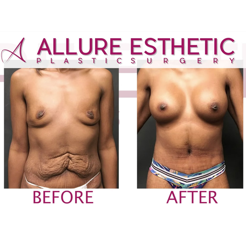 Tummy Tuck Results with Breast Augmentation Mommy Makeover Seattle
