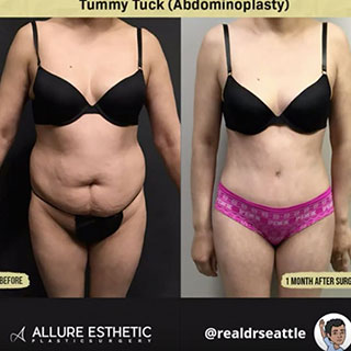Tummy Tuck (Abdominoplasty ) from Dr. Sajan aka Dr. Seattle