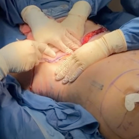 Panniculectomy Surgery: Tummy Tuck to Remove Saggy Skin & Fat from Weight Loss/Pregnancy!