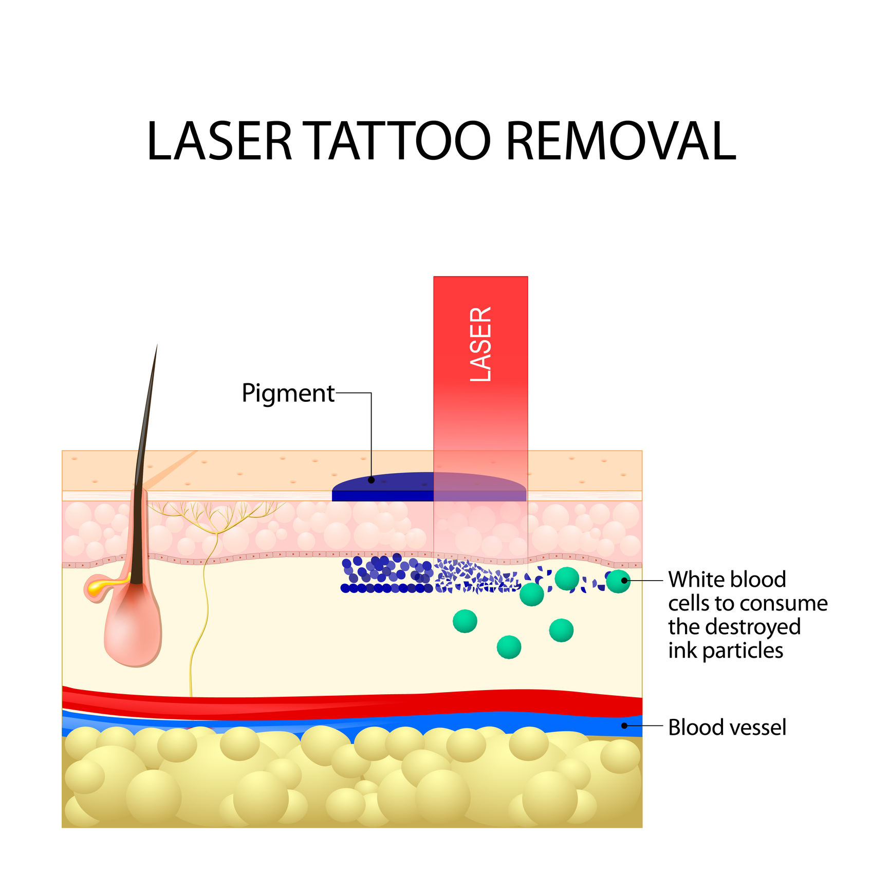 The Tattoo Removal Process, Explained | Lexington Tattoo Removal