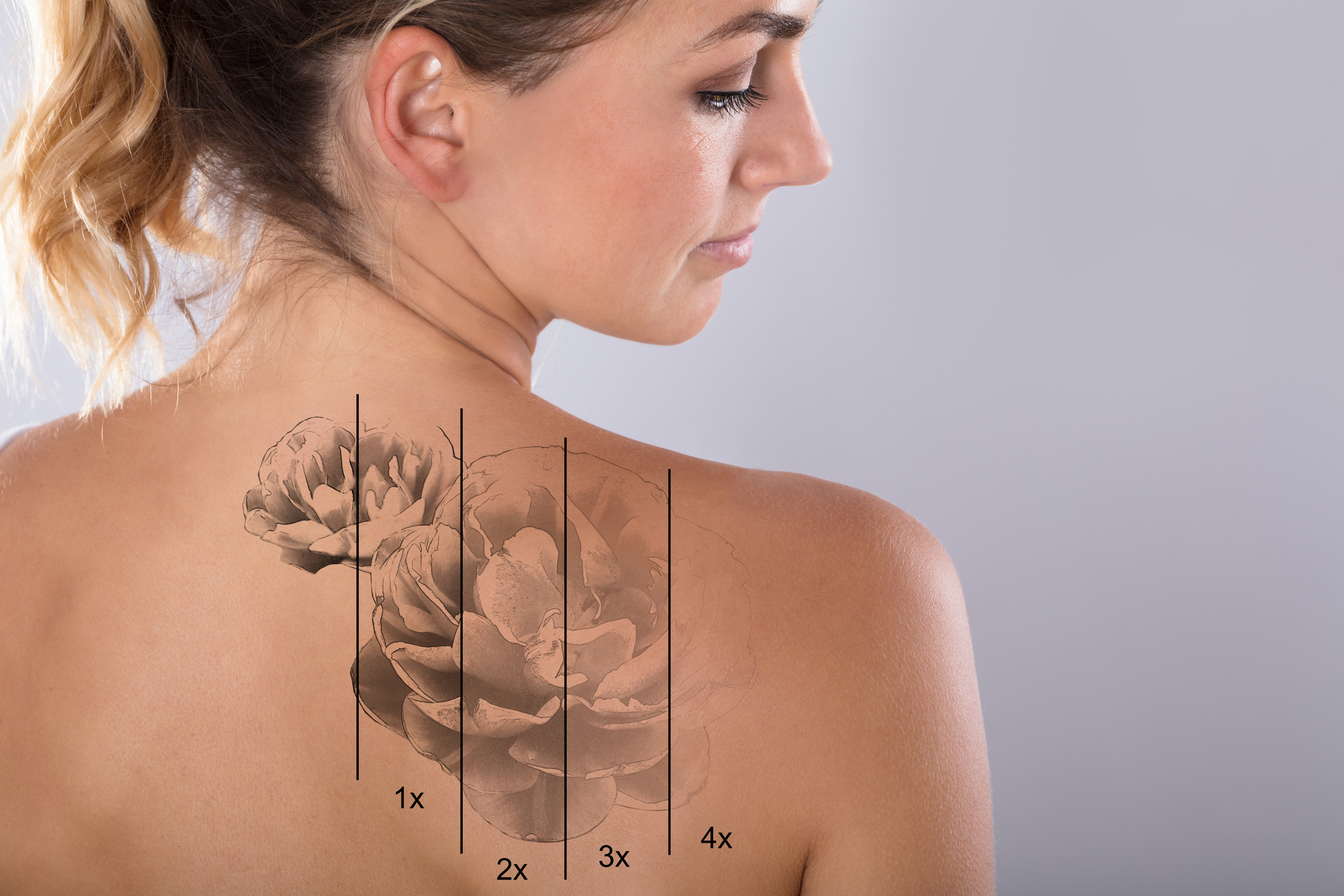 Tattoo Removal - Affiliated Dermatology
