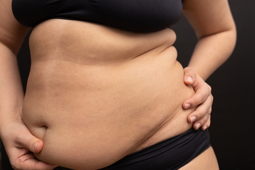 What Exactly Is a 'Mother's Apron' Belly?