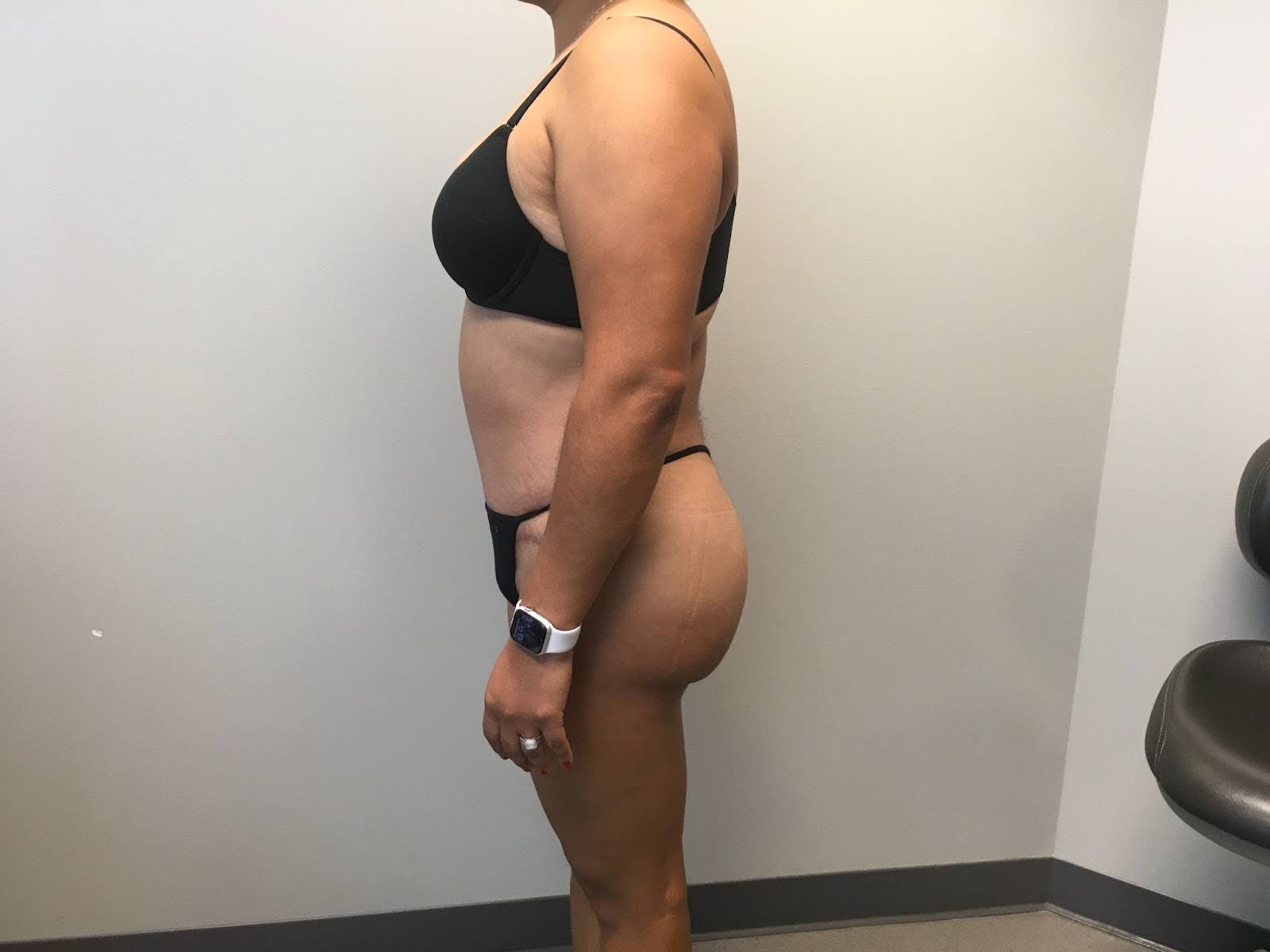 Modal showing extended tummy tuck