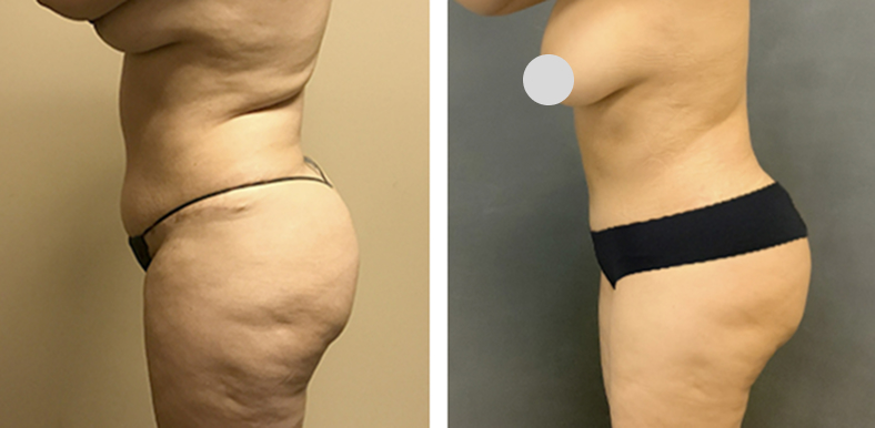 Mommy Makeover W Bbl Before After 02