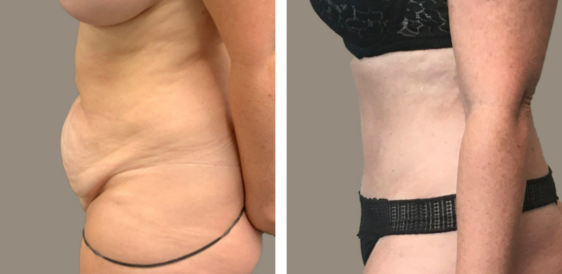 Mommy Make Over Before After 01