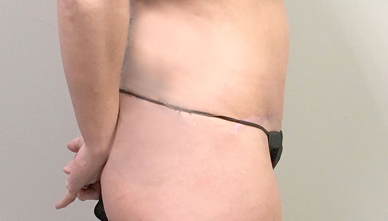 Tummy Tuck Vancouver, BC, Abdominoplasty