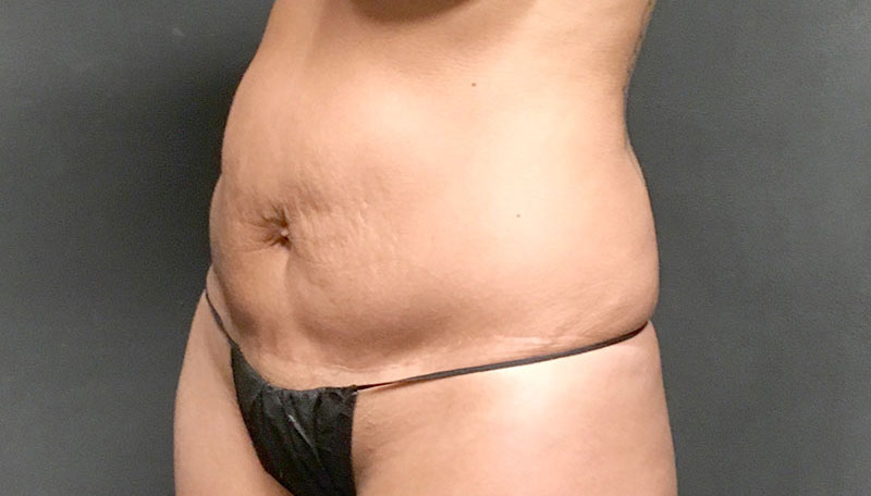 Tummy Tuck Revision Seattle