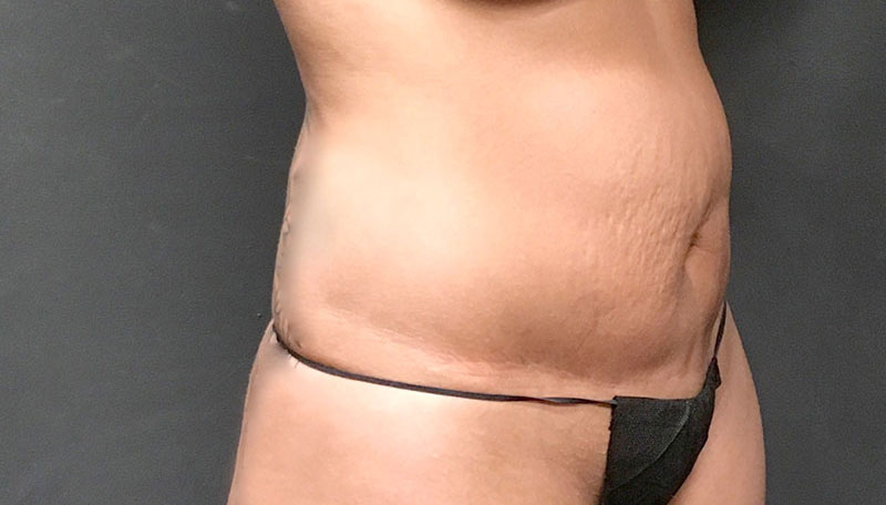 Patient 176763660  Tummy Tuck Revision by Dr. Booth Before