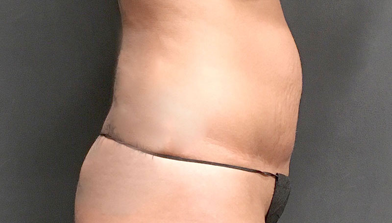 Hi everyone tummy tuck belly button. It's been 14 weeks. I might need a  revision. What do you guys think? I'm not happy with it. Using Mederma, and  silicone strips. I've noticed