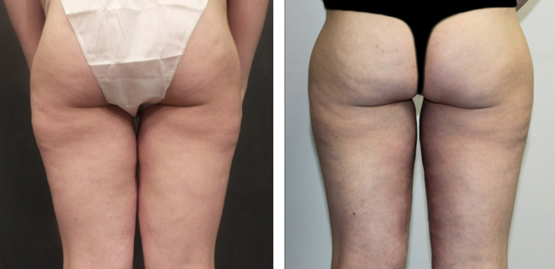 Thigh Lift Before After 02