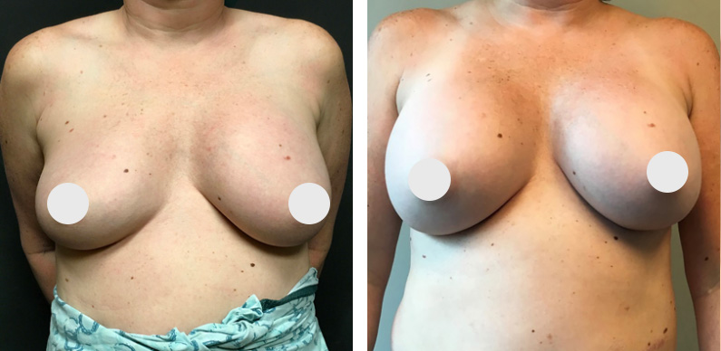 Breast Augmentation Revision Before After 02