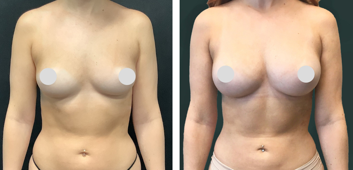 Fat Transfer To Breast Before After 01