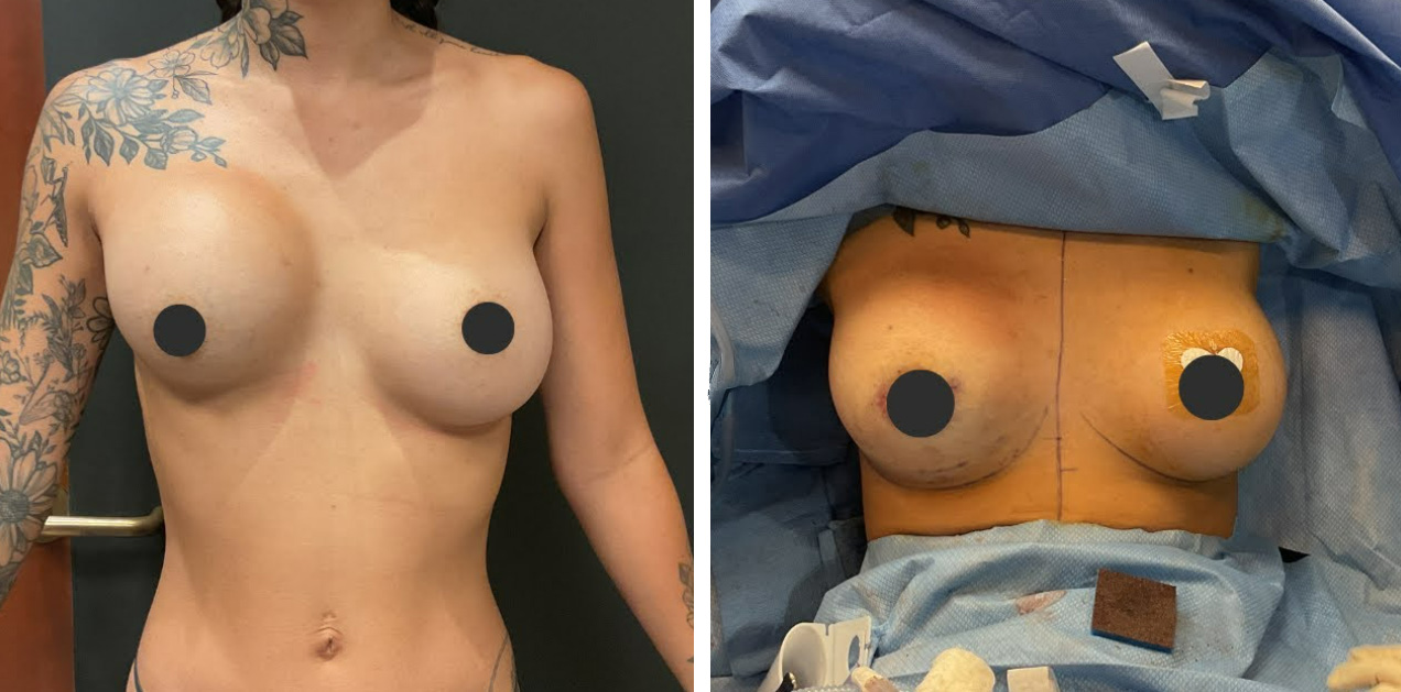 Capsular Contracture Revision Before After 01