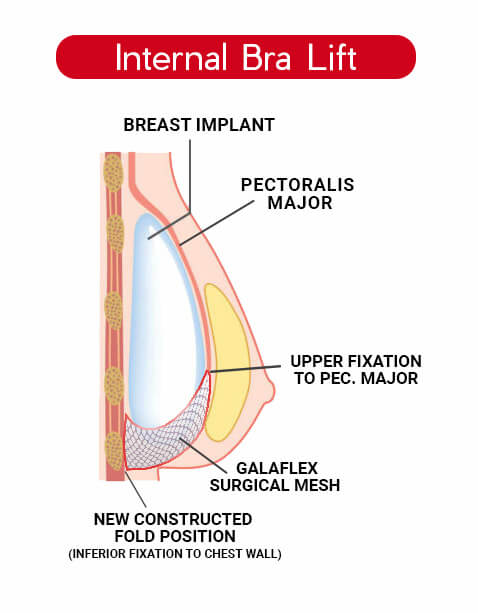 How Does An Internal Bra Technique Work?