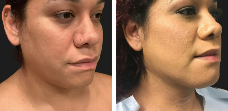 Lower Face Contouring 04