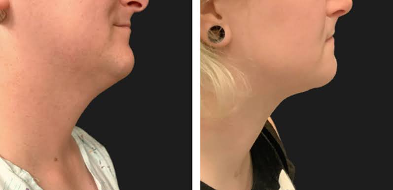 Lower Face Contouring 055