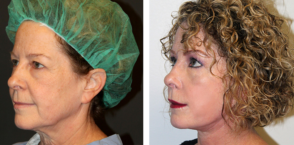 Face Lift Before After 01