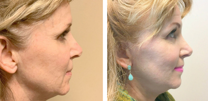 Facial Fat Transfer Before After 02