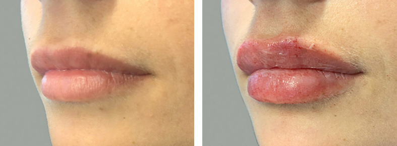 Lip Filler 03
