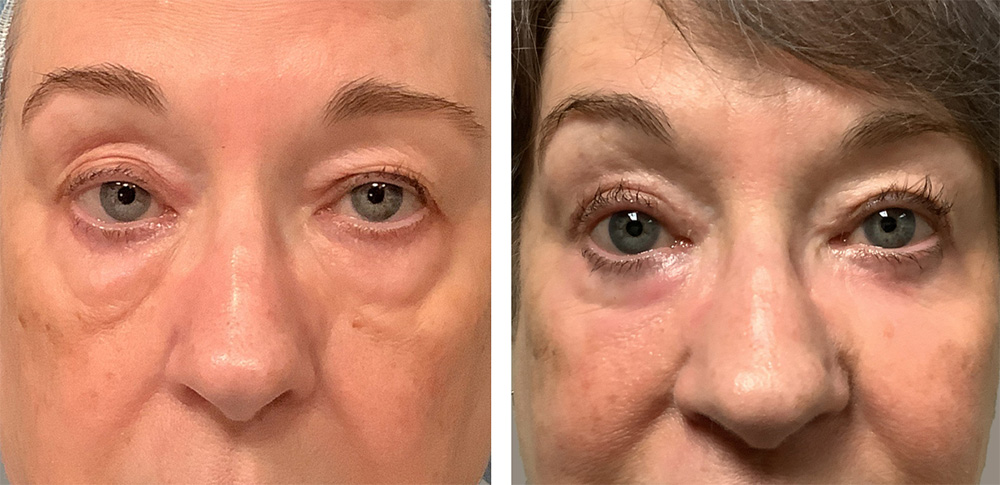 Blepharoplasty Before After 01