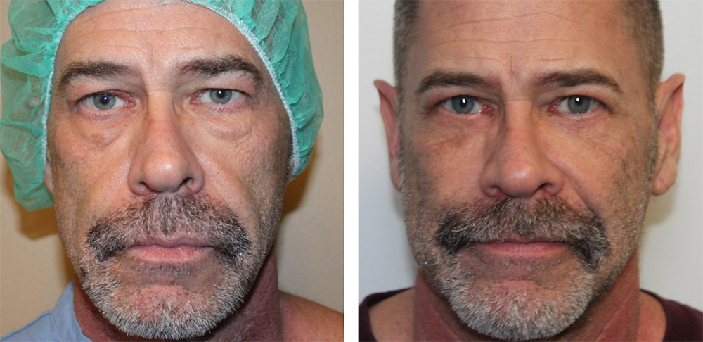 Lower Blepharoplasty Before After 02 Allure