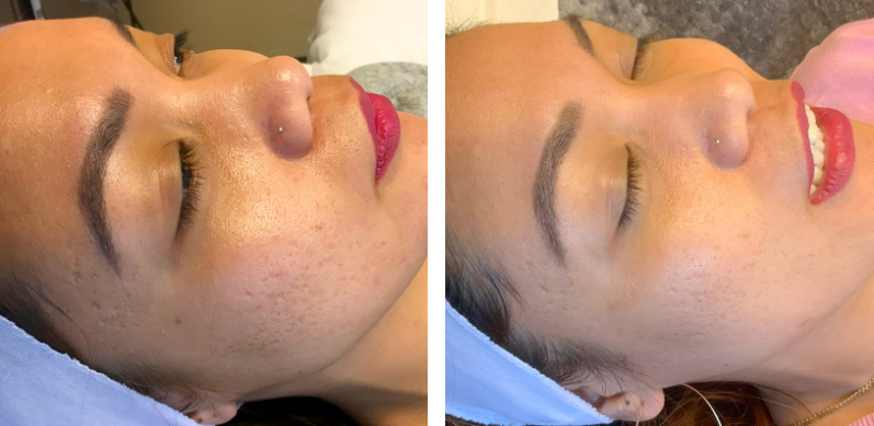Microneedling Before After 02