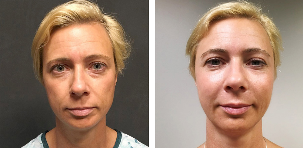 Mid Facelift Before After 01