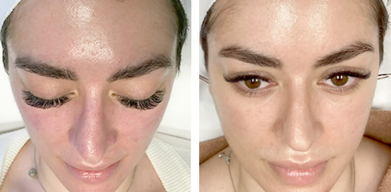 Microneedling Before After 01