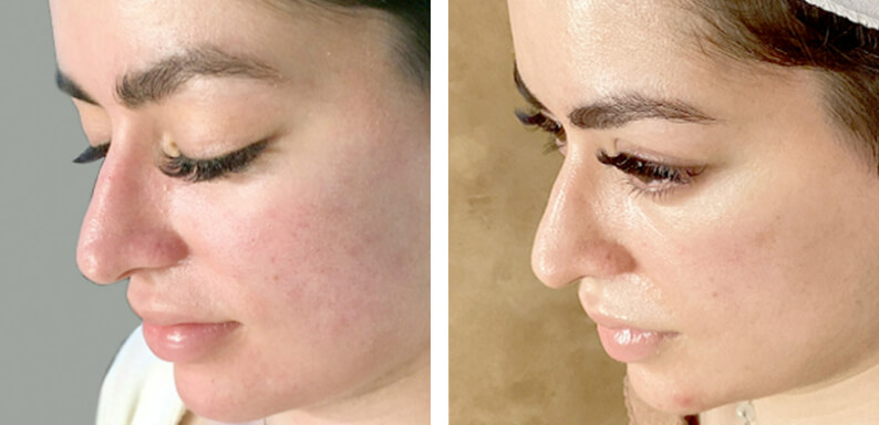 Microneedling Before After 03