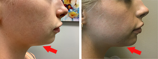 Kybella Before After 02