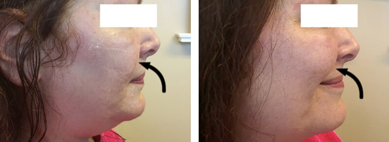 Non Surgical Cheek Enhancement Before After