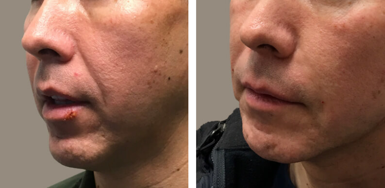Non Surgical Jawline Enhancement Before After 02