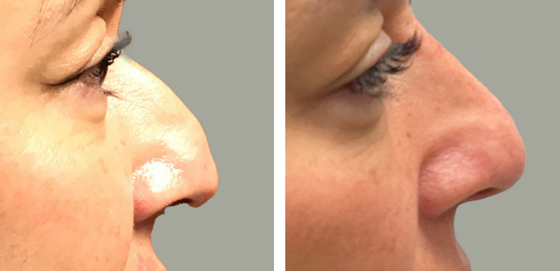 Non Surgical Rhinoplasty Before After 01