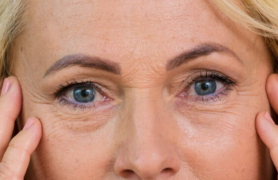 Revision Blepharoplasty 02
