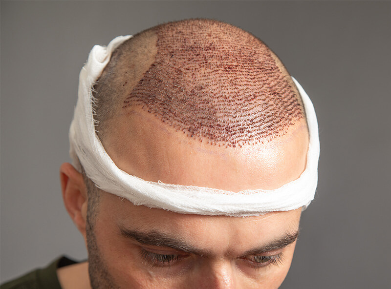 FUT Hair Transplant Scar Revision 02