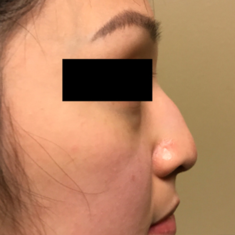 Asian Rhinoplasty Seattle & Everett - Nose Surgery
