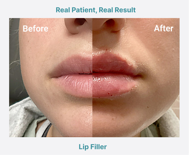 lipfiller Before/After Photo