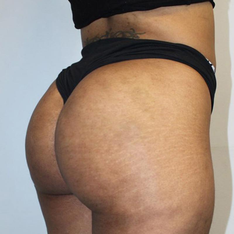 Non Surgical Brazilian Butt Lift Before & After 01