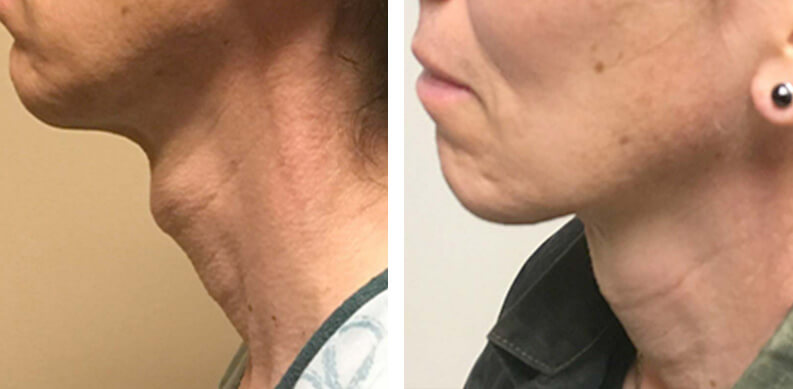 Tracheal Shave Before After 011