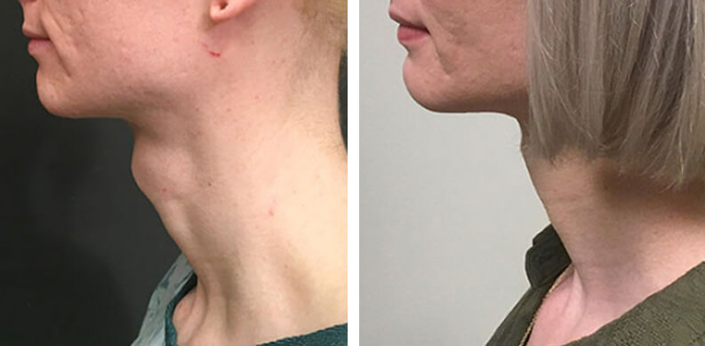 Tracheal Shave Before After 022