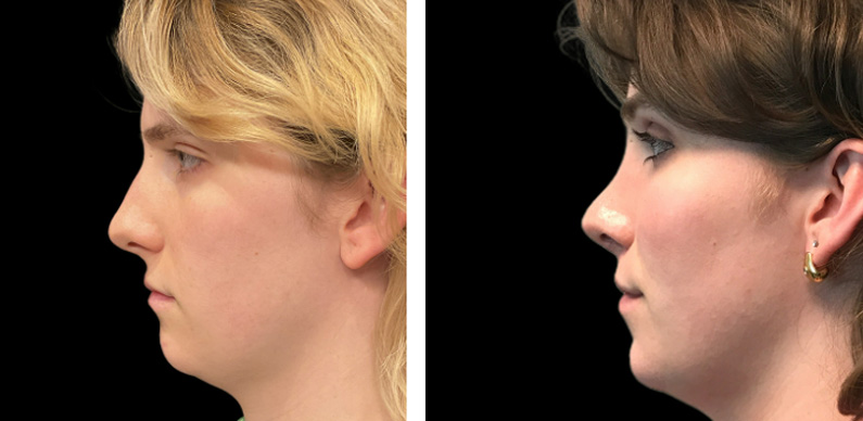 Transgender Rhinoplasty Before After 02